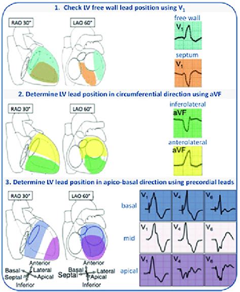 lv leads|coronary sinus pacer lead.